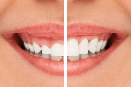 Diseño De Sonrisas