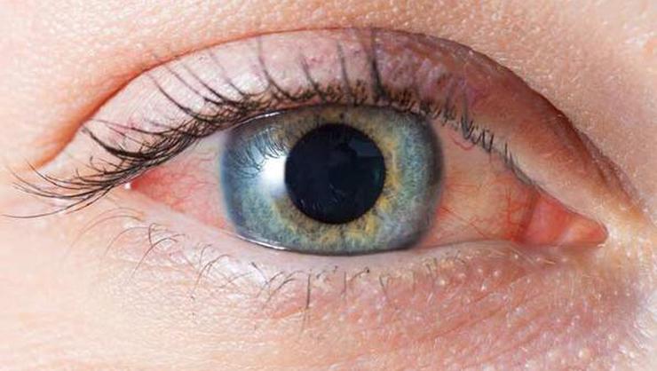 Glaucoma (Eye Pressure)