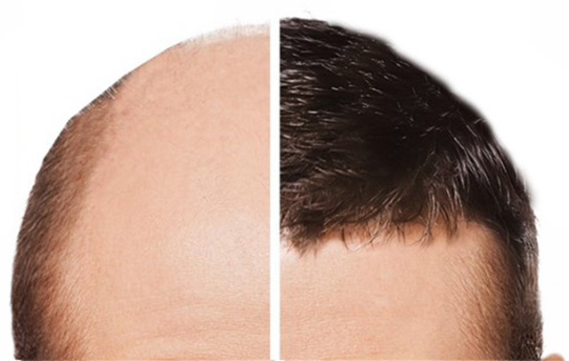 زراعة الشعر عن طريق إستخراج وحدة البصيلات (FUE)