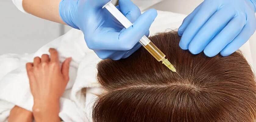 العلاج عن طريق البلازما الغنية بالصفائح الدموية (PRP) - ميزوثيرابي الشعر