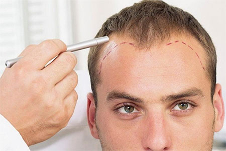 Was Ist Eine Haartransplantation?
