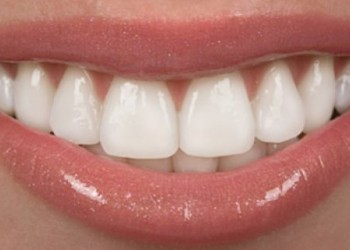 Estética De La Gingiva