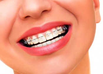 Blanqueamiento De Los Dientes